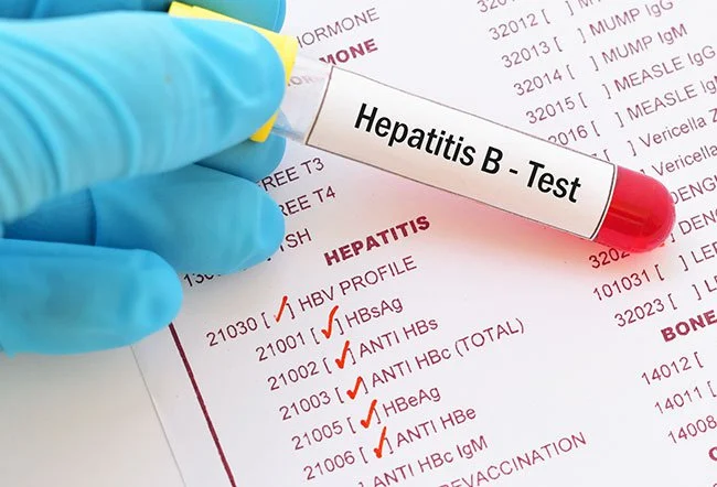 Hepatitis Bs (Surface) Antigen (HBsAb IgG) Test